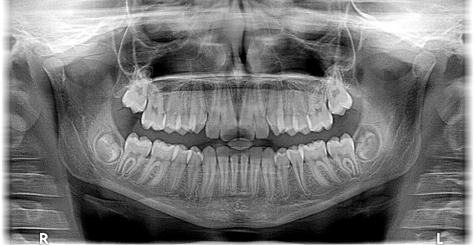 치열, 치과, 교정, 악골수술(출처=PIXABAY)