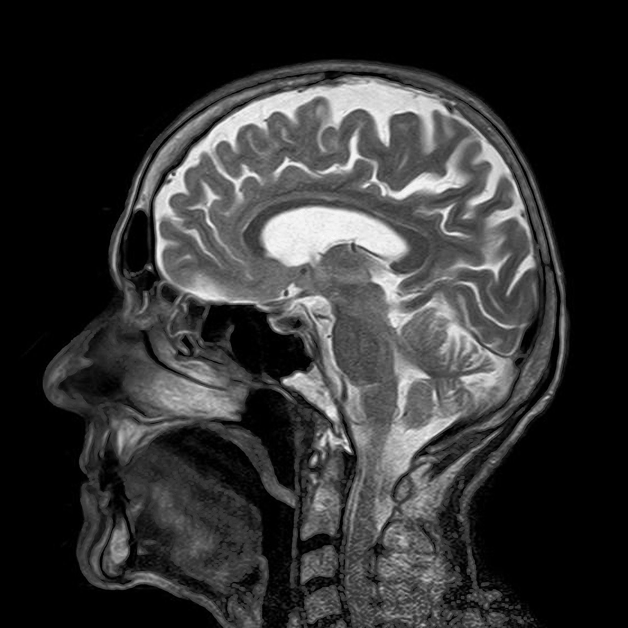 mri, 뇌, 자기 공명 (출처=PIXABAY)