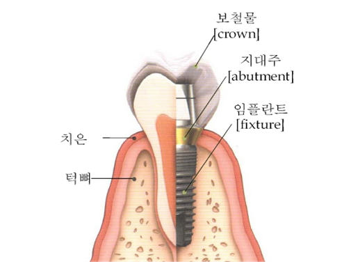 임플란트 구조(출처=한국소비자원)